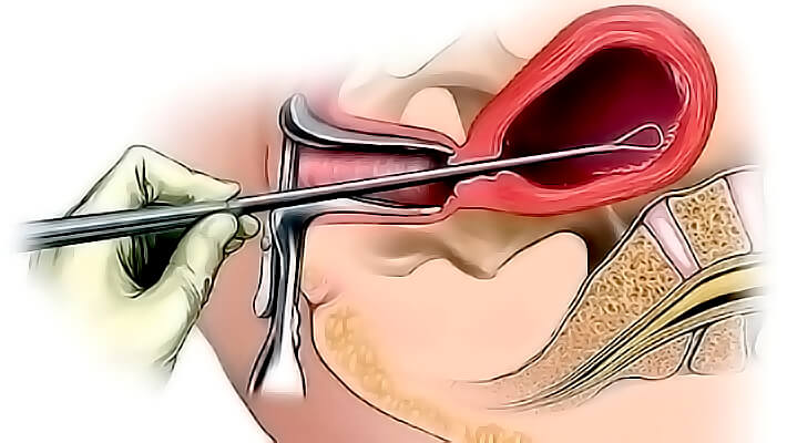РДВ после гистероскопии