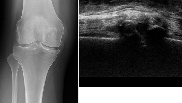 УЗИ коленного сустава