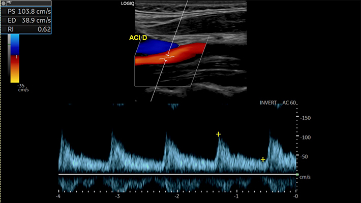 УЗИ брахиоцефальных артерий