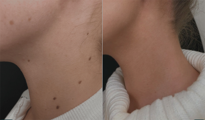 Реабилитация и уход после удаления родинки лазером