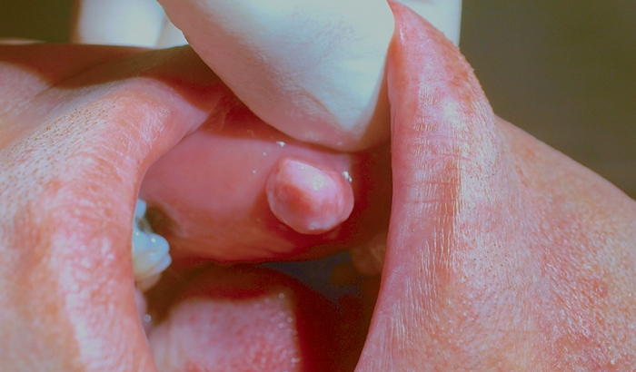 Удаление фибромы