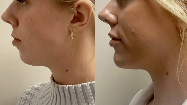 Контурная пластика подбородка