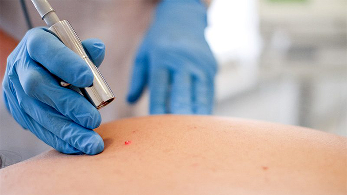 Что делать после удаления папиллом лазером