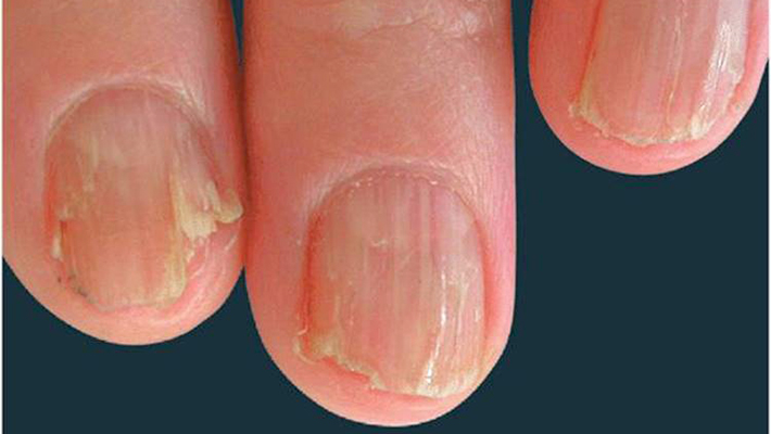 Ониходистрофия ногтеи