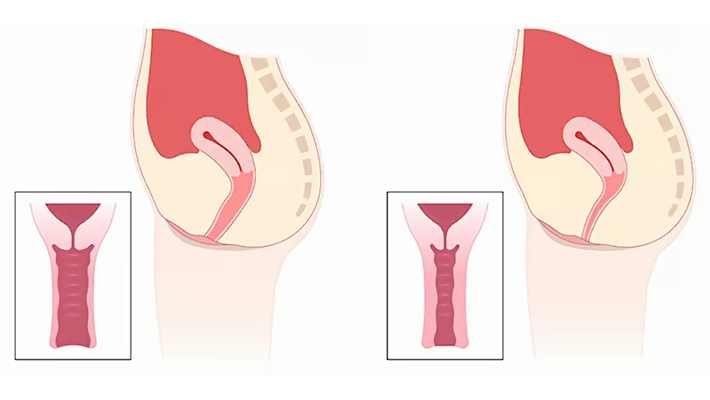 Растяжение влагалища и слабый тонус вагинальных мышц
