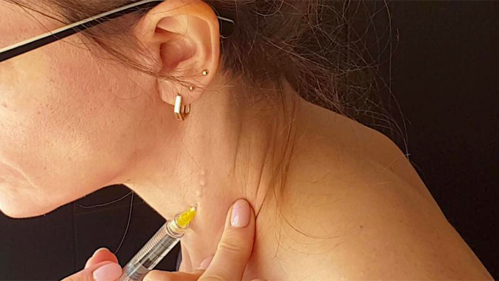 Мезотерапия шеи