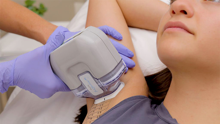 Лечение гипергидроза лазером