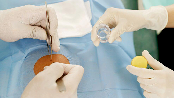 Как проходит биопсия кожи