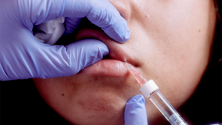 Биоревитализация губ