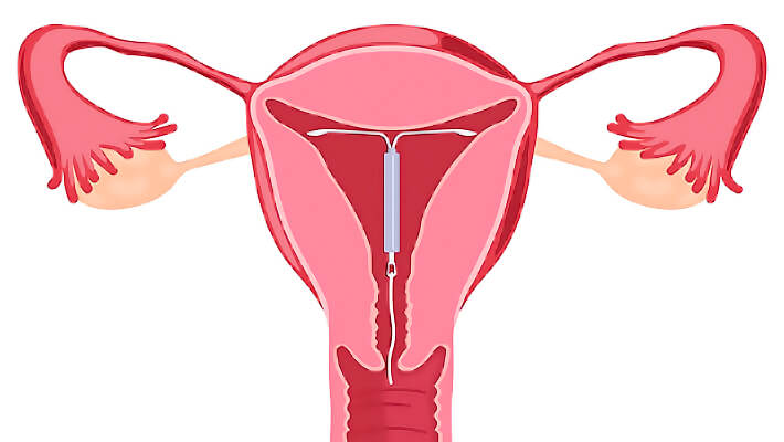 Внутриматочная спираль Мирена