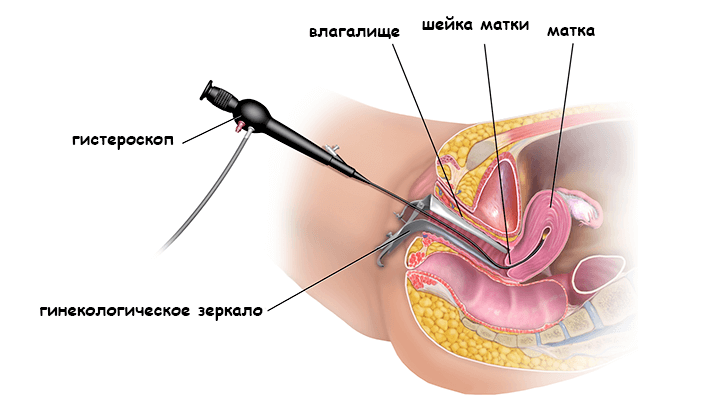 Гистероскопия матки
