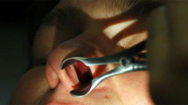 Как проводится риноскопия