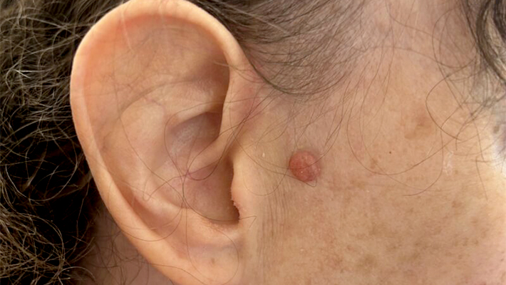 Дерматофиброма кожи