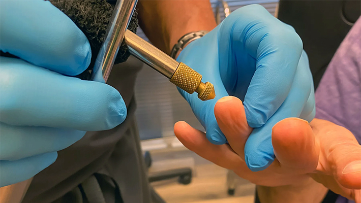 Удаление родинок азотом