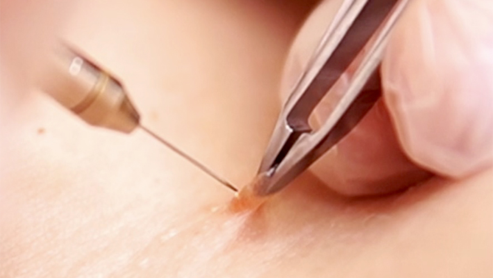 Удаление папиллом электрокоагуляцией