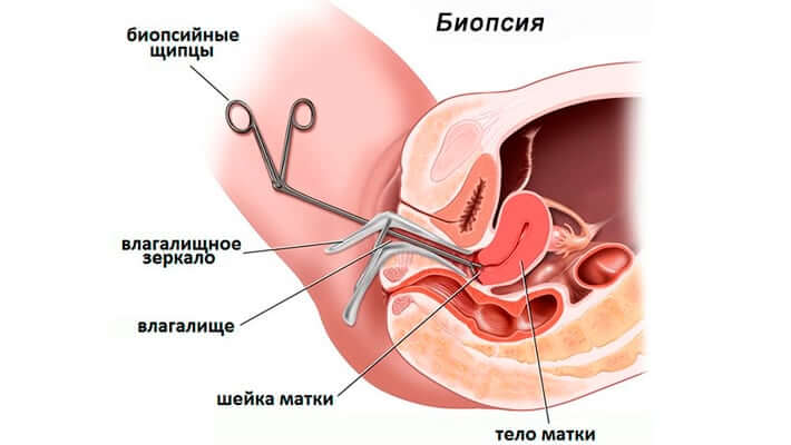 Схема прицельной биопсии шейки матки