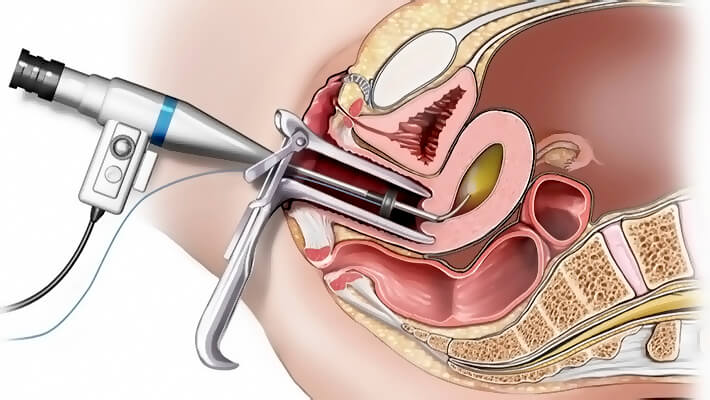 Офисная гистероскопия