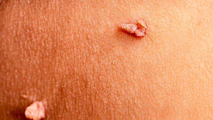 Удаление кондилом