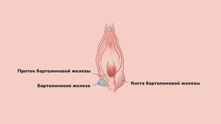 Удаление кисты бартолиновой железы