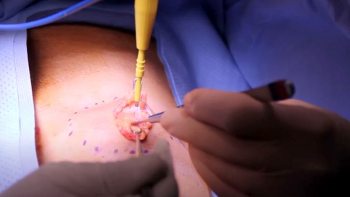 Радиоволновое удаление липомы