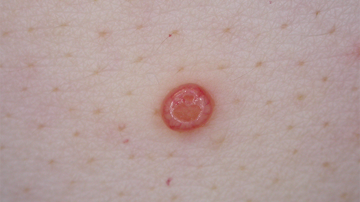 Симптомы контагиозного моллюска и его лечение