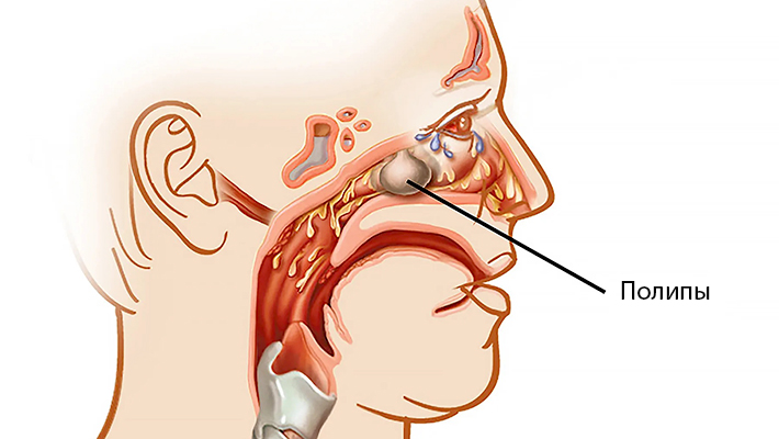 Методы удаления полипов в носу