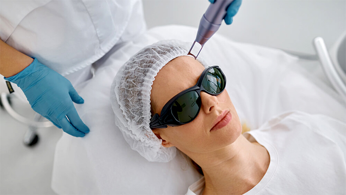 Лазерный пилинг лица
