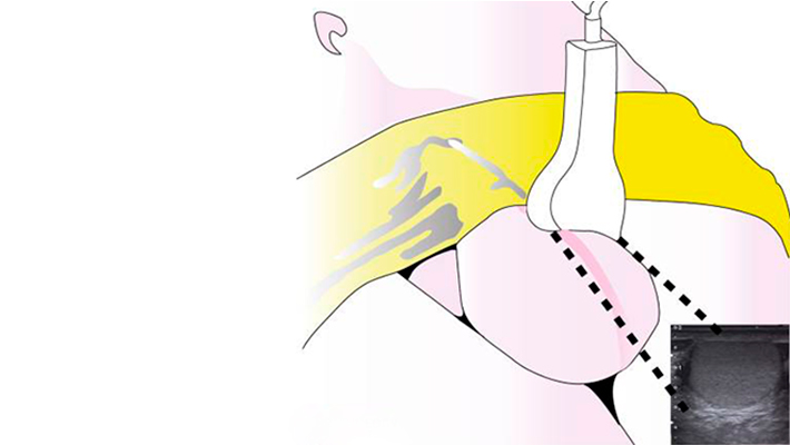 Все об УЗИ мошонки