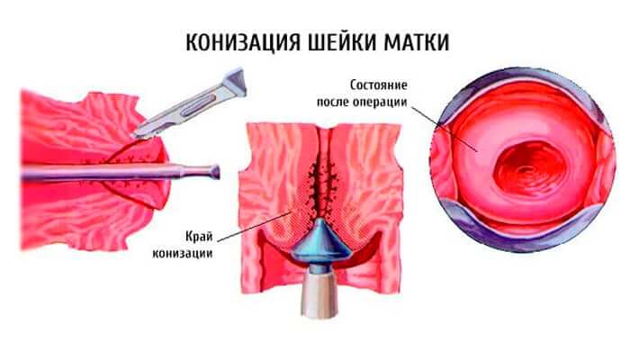 Конизация шейки матки схематично