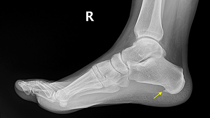 Пяточная шпора