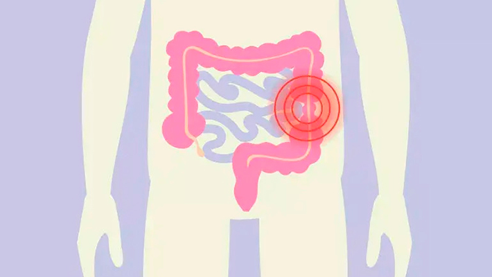 Синдром раздраженного кишечника
