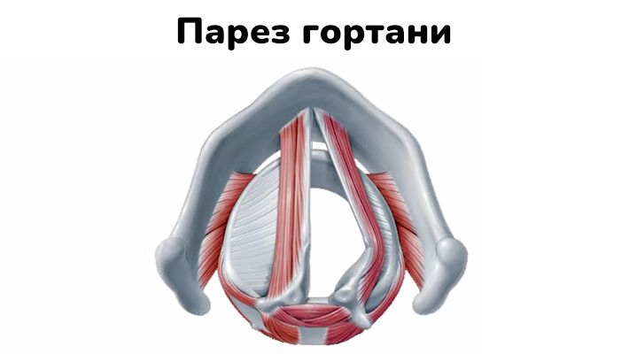 Парез гортани