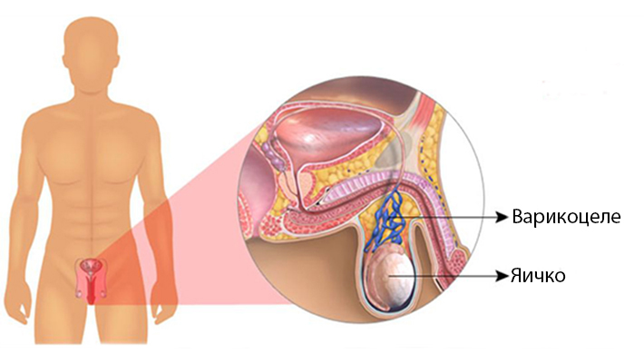 Операция при варикоцеле