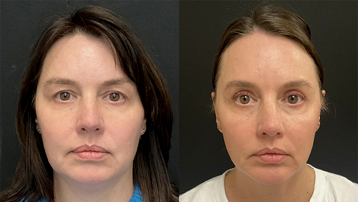 Контурная пластика скул