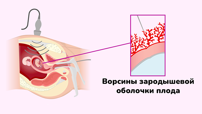 Биопсия хориона