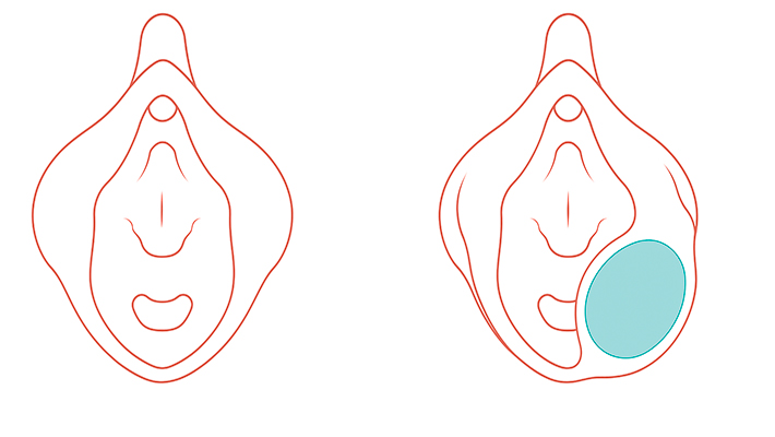 Киста половой губы