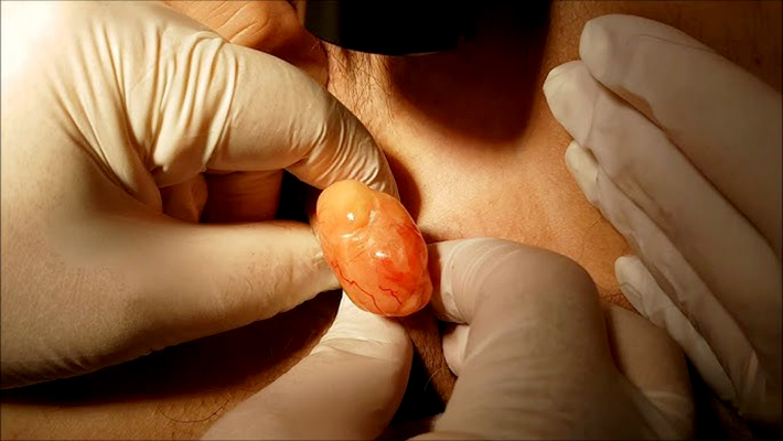 Удаление липомы