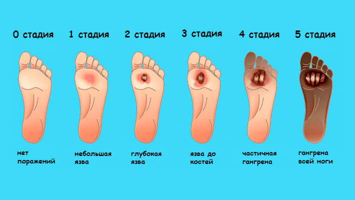 Стадии диабетической стопы