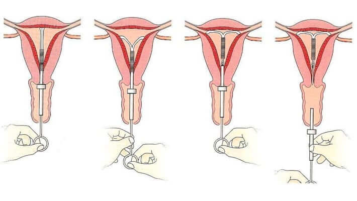 Как проходит установка внутриматочной спирали