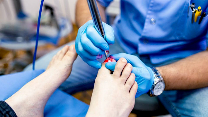 Лазерное лечение грибка ногтей