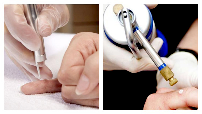 Чем лучше удалить бородавку: лазером или азотом