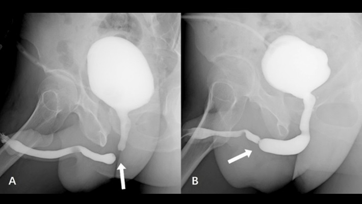 Уретрография