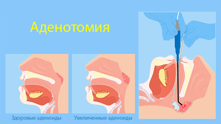 Что такое аденотомия