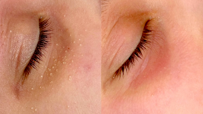 Радиоволновое удаление милиумов