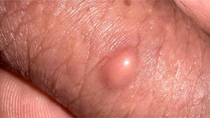 Удаление жировика на мошонке