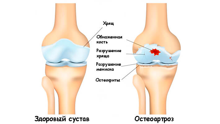 Остеоартроз