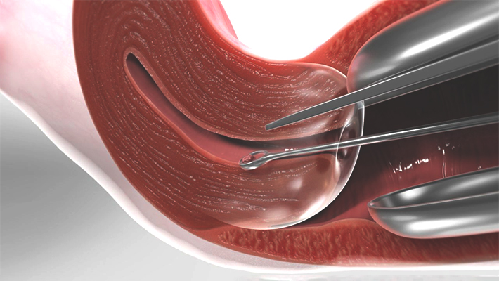 Раздельное диагностическое выскабливание