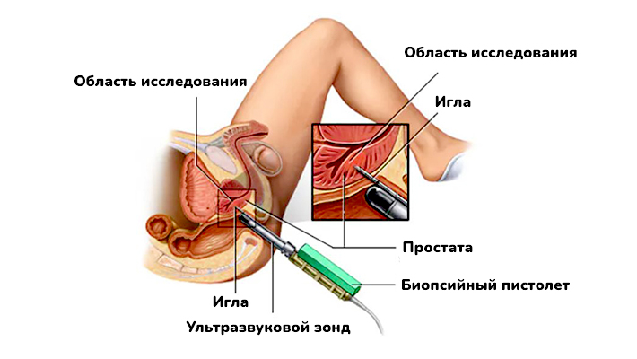 Биопсия простаты