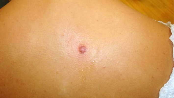 Удаление дерматофибром