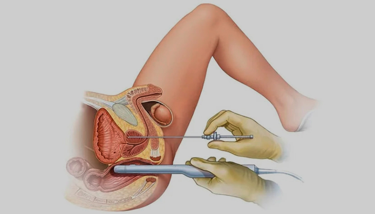 Биопсия предстательной железы